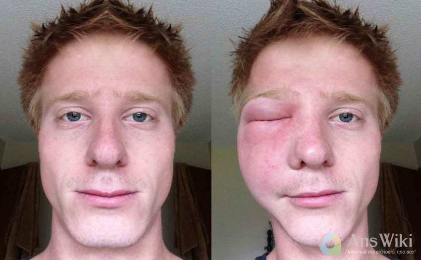 Хлопець до і після укусу бджоли