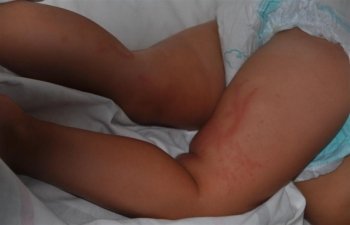 Дитину вжалила медуза. Що робити, як зменшити біль?